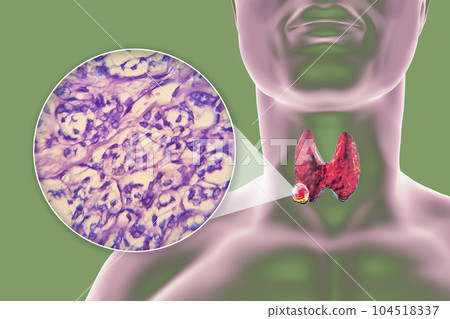 A 3D scientific illustration showcasing a human body with transparent skin, revealing a tumor in his thyroid gland, along with a micrograph image of thyroid cancer. A 3D scientific illustration showcasing a human body with transparent skin, revealing a tumor in his thyroid gland, along with a micrograph image of thyroid cancer. 104518337
