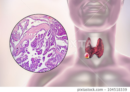 A 3D scientific illustration showcasing a human body with transparent skin, revealing a tumor in his thyroid gland, along with a micrograph image of thyroid cancer. A 3D scientific illustration showcasing a human body with transparent skin, revealing a tumor in his thyroid gland, along with a micrograph image of thyroid cancer. 104518339
