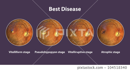 Best vitelliform macular dystrophy stages, scientific illustration 104518340