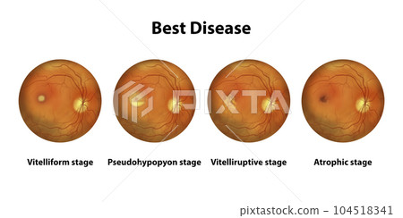 Best vitelliform macular dystrophy stages, scientific illustration Best vitelliform macular dystrophy stages, scientific illustration 104518341