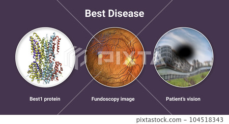 Best disease. Best vitelliform macular dystrophy, illustration Best disease. Best vitelliform macular dystrophy, illustration 104518343