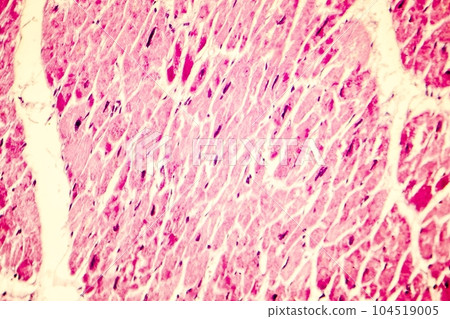Heart hypertrophy photomicrograph 104519005