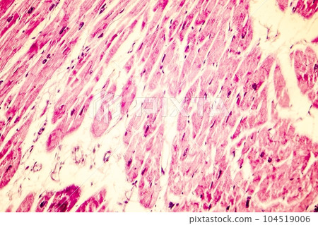Heart hypertrophy photomicrograph Heart hypertrophy photomicrograph 104519006