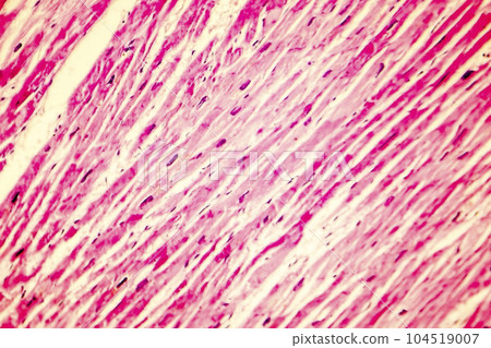 Heart hypertrophy photomicrograph Heart hypertrophy photomicrograph 104519007