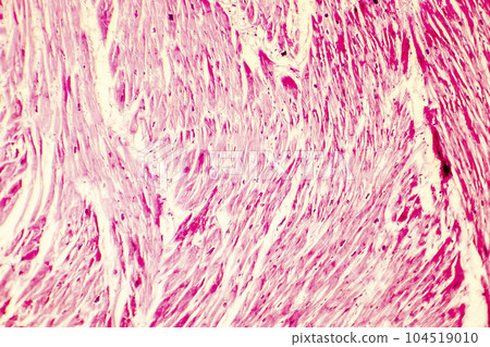 Heart hypertrophy photomicrograph Heart hypertrophy photomicrograph 104519010