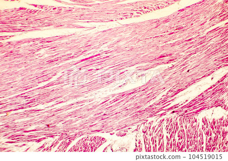 Heart hypertrophy photomicrograph 104519015