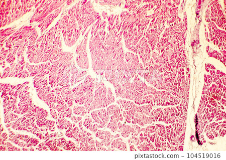 Heart hypertrophy photomicrograph Heart hypertrophy photomicrograph 104519016