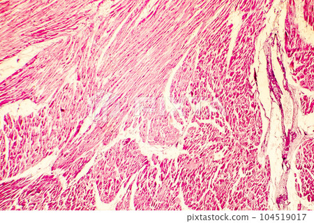 Heart hypertrophy photomicrograph Heart hypertrophy photomicrograph 104519017