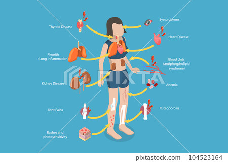 3D Isometric Flat Vector Conceptual Illustration of Lupus Erythematosus 104523164