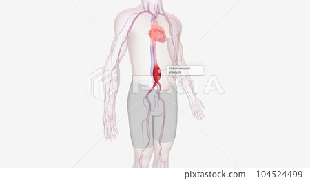 Abdominal aortic aneurysm occurs when the abdominal aorta balloons out due to the weakening of the wall of the artery. Abdominal aortic aneurysm occurs when the abdominal aorta balloons out due to the weakening of the wall of the artery. 104524499