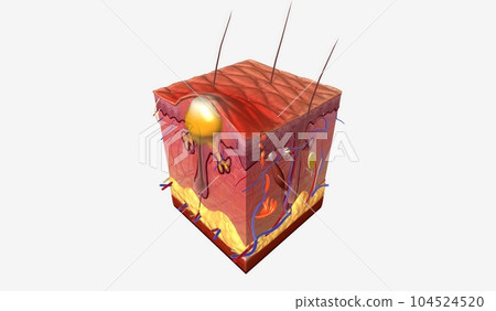 Pustules are a type of acne characterized by large, inflamed bumps with pus filled tips Pustules are a type of acne characterized by large, inflamed bumps with pus filled tips 104524520