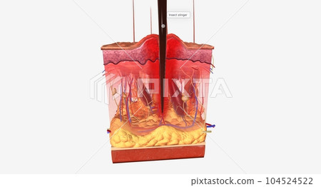 Skin reaction after insect bite Skin reaction after insect bite 104524522