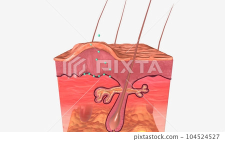 Anal Warts in Skin Tissue Anal Warts in Skin Tissue 104524527