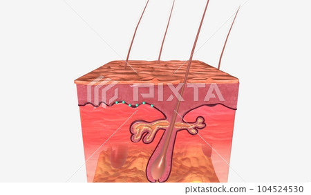 Anal Warts in Skin Tissue Anal Warts in Skin Tissue 104524530