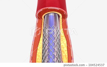 Angioplasty is a minimally invasive procedure that uses a cathet 104524537