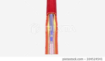 Angioplasty is a minimally invasive procedure that uses a catheter with a balloon tip to expand your blocked artery. 104524541