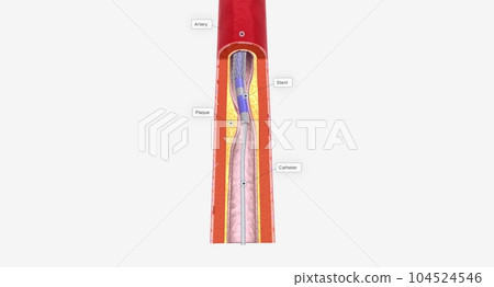 Angioplasty is a minimally invasive procedure that uses a catheter with a balloon tip to expand your blocked artery. 104524546