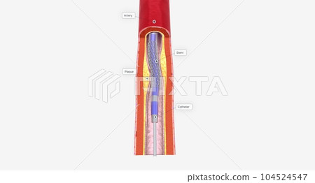 Angioplasty is a minimally invasive procedure that uses a catheter with a balloon tip to expand your blocked artery. 104524547