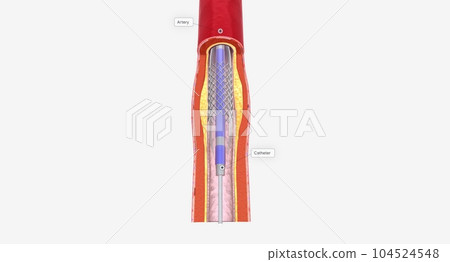 Angioplasty is a minimally invasive procedure that uses a catheter with a balloon tip to expand your blocked artery. 104524548