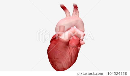 The enlarged portion of the aortic arch is replaced with a synthetic graft. 104524558