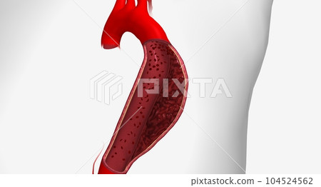 Aortic dissection is a serious cardiovascular condition characterized by a tear in the inner layer of the aorta. 104524562