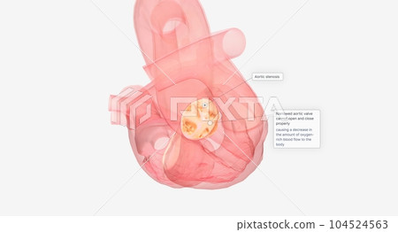 Narrowed aortic valve cannot open and close properly 104524563