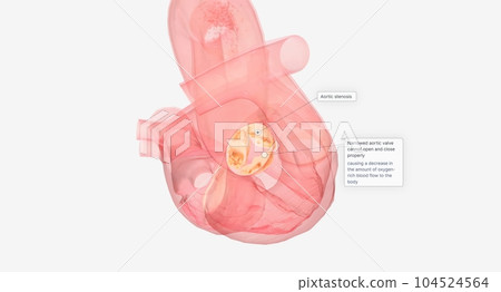 Narrowed aortic valve cannot open and close properly Narrowed aortic valve cannot open and close properly 104524564