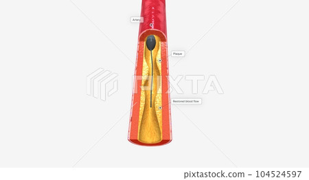 Atherectomy is a minimally invasive procedure that removes plaque using a catheter with a drill-like piece at the end 104524597