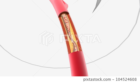 Atherosclerosis is the plaque buildup in the walls of the arteries Atherosclerosis is the plaque buildup in the walls of the arteries 104524608