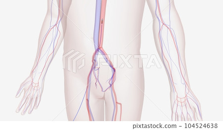 Will insert a catheter through a large artery near the groin or Will insert a catheter through a large artery near the groin or 104524638