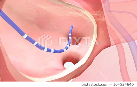 Catheter placement in the heart Catheter placement in the heart 104524640