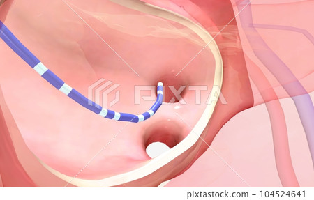 Catheter placement in the heart 104524641