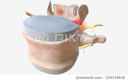 The Compression of Spinal Canal The Compression of Spinal Canal 104524656