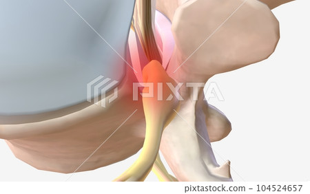 The Compression of Spinal Canal The Compression of Spinal Canal 104524657