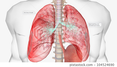 During normal breathing, oxygen rich air enters through your nose or mouth and reaches the lungs through your airways. During normal breathing, oxygen rich air enters through your nose or mouth and reaches the lungs through your airways. 104524690