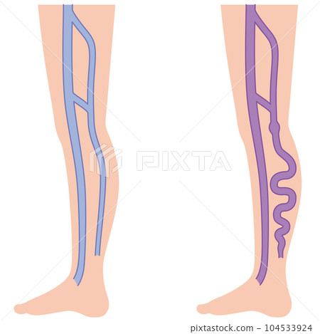 下肢靜脈曲張疾病醫療 104533924