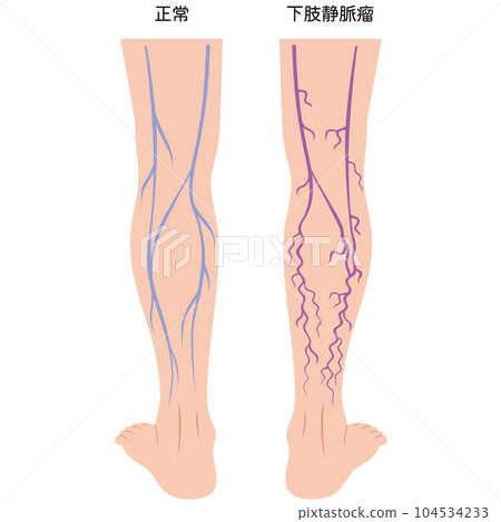 下肢靜脈曲張疾病醫療 下肢靜脈曲張疾病醫療 104534233