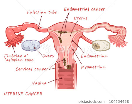 子宮癌、子宮內膜癌、宮頸癌 子宮癌、子宮內膜癌、宮頸癌 104534438