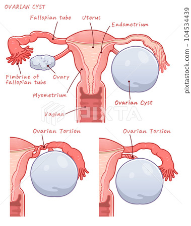 Ovarian cyst, ovarian cyst, stem torsion, Ovarian torsion 104534439