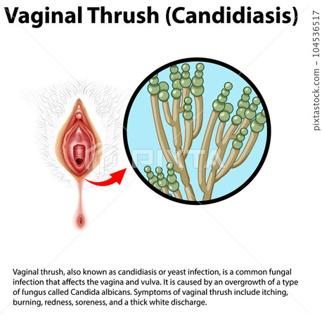 Vaginal Thrush (Candidiasis) infographic with explanation 104536517