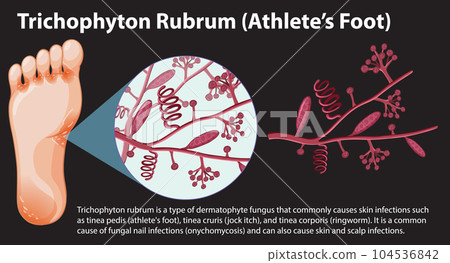 Trichophyton Rubrum fungal infection 104536842