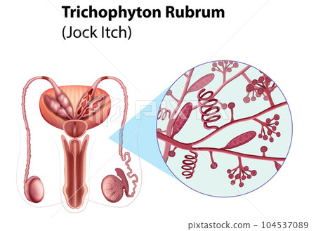 Trichophyton Rubrum fungal infection Trichophyton Rubrum fungal infection 104537089