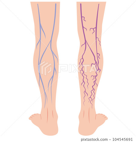Lower extremity varicose vein disease medical care 104545691