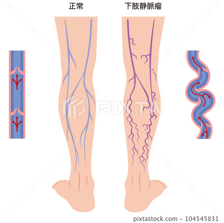 Lower extremity varicose vein disease medical care 104545831