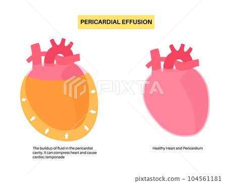 Pericardial effusion heart 104561181