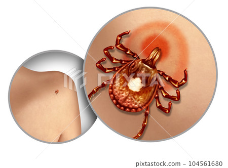 Deer Tick On Skin 104561680