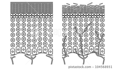 Line drawing of healthy and rough skin structure (cross section of human skin) Line drawing of healthy and rough skin structure (cross section of human skin) 104568931