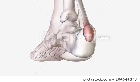 Haglund's deformity is bone growth on the back of the heel 104644878