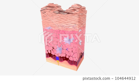The Accumulation of keratinized cells The Accumulation of keratinized cells 104644912