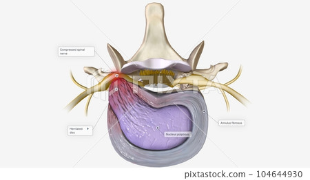 A herniated disc is a condition characterized by structural changes to an intervertebral disc A herniated disc is a condition characterized by structural changes to an intervertebral disc 104644930